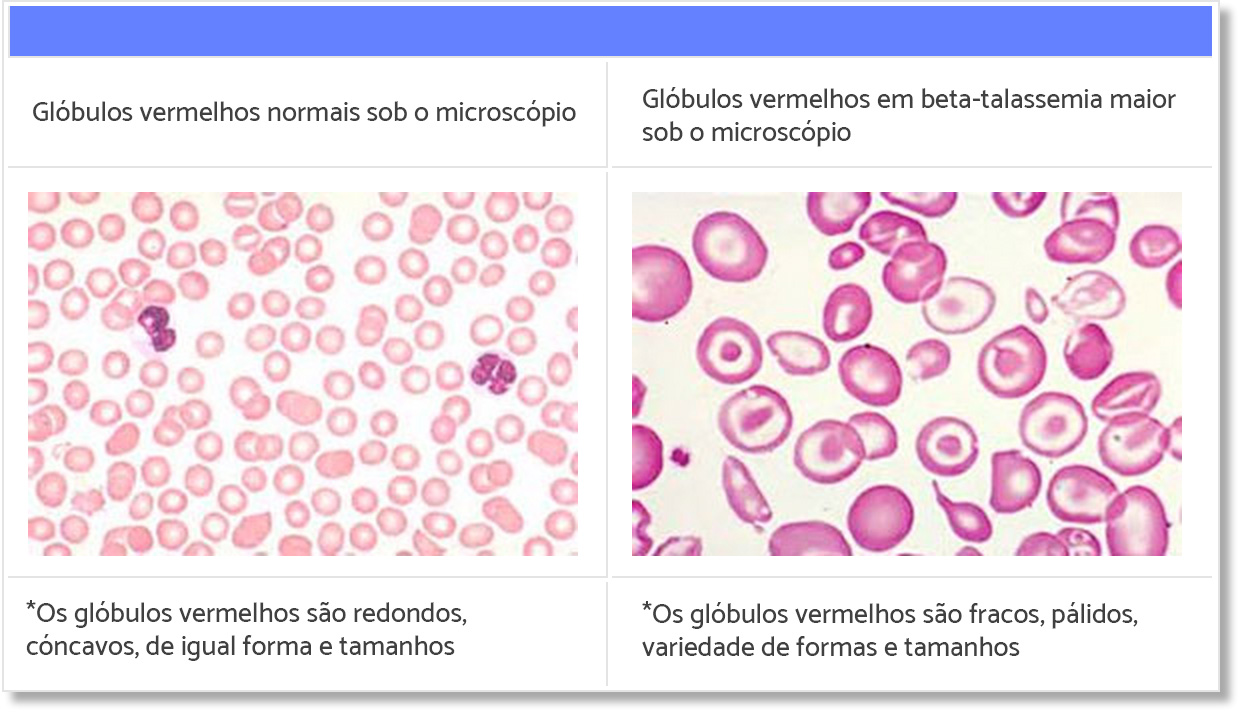 Imagem com explicação dos glóbulos vermelhos em talassemicos 